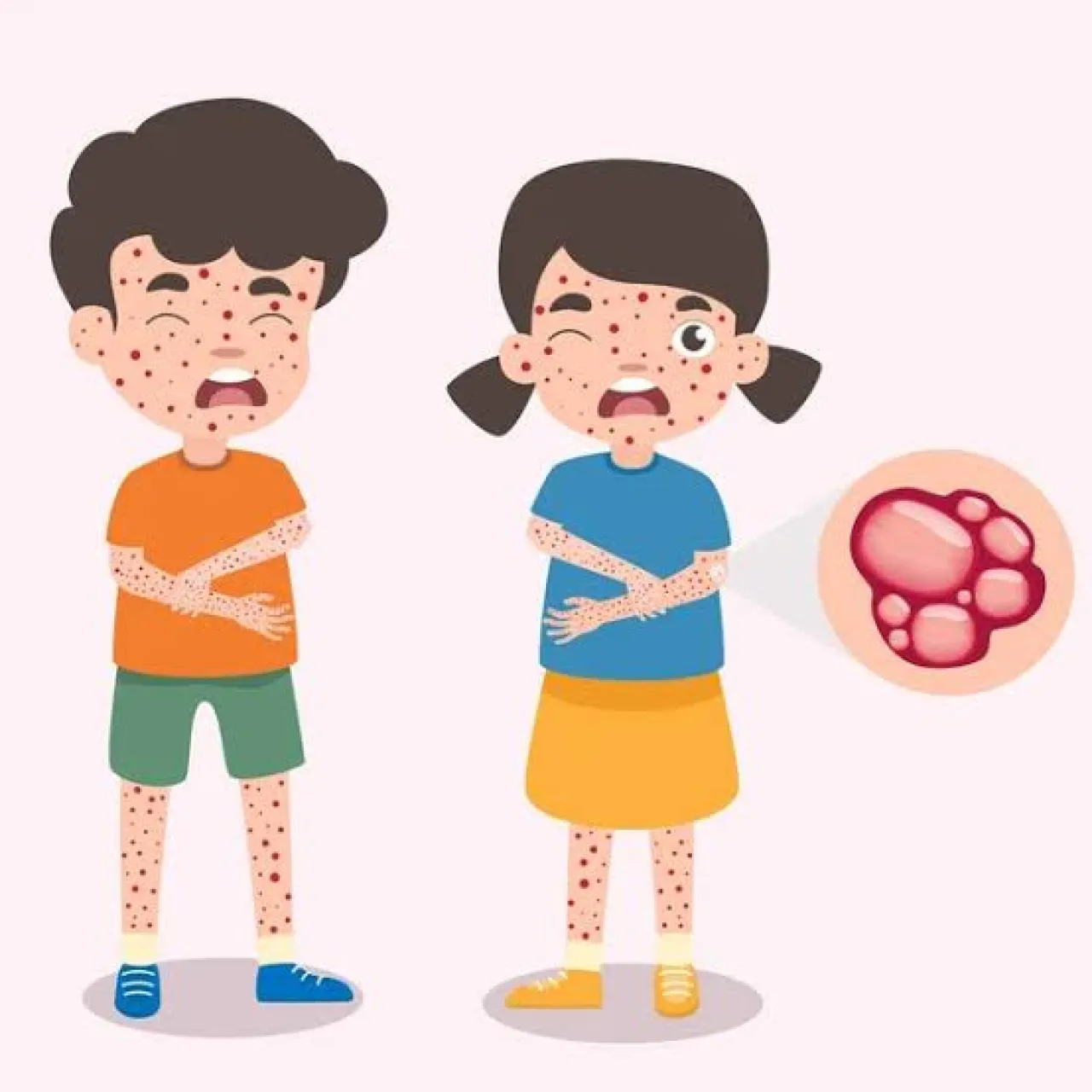 SISWA DI SITUBONDO MENGALAMI CACAR AIR (VARICELLA) DAN DIPASTIKAN BUKAN KASUS MPOX